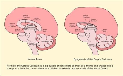 Dysgenesis of the corpus callosum .